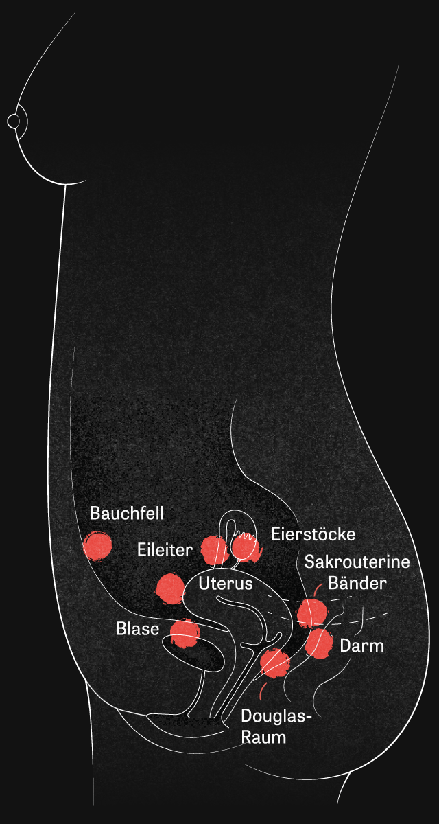 Endometriose: Warum Endometriose so schmerzhaft ist | DIE ZEIT